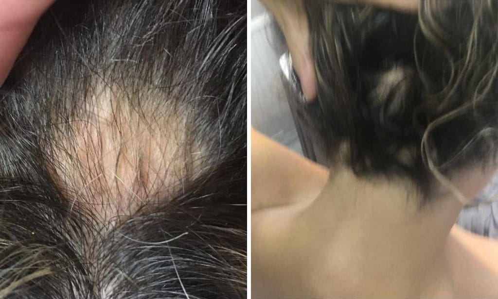 Before and after images showing hair regrowth on a person's scalp.